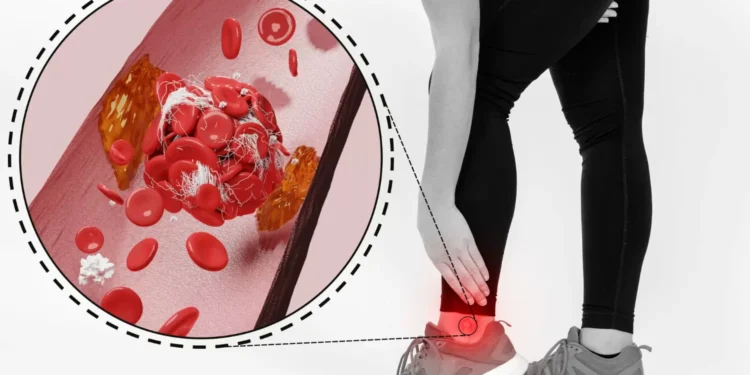 Hipercalcemia: Identifica los síntomas del exceso de calcio en la sangre